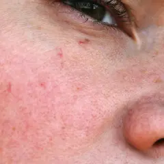 Nahaufnahme der Haut mit feinen roten Äderchen, die als besenreiser im Gesicht sichtbar sind.