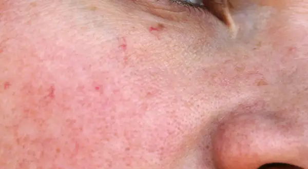 Nahaufnahme der Haut mit feinen roten Äderchen, die als besenreiser im Gesicht sichtbar sind.