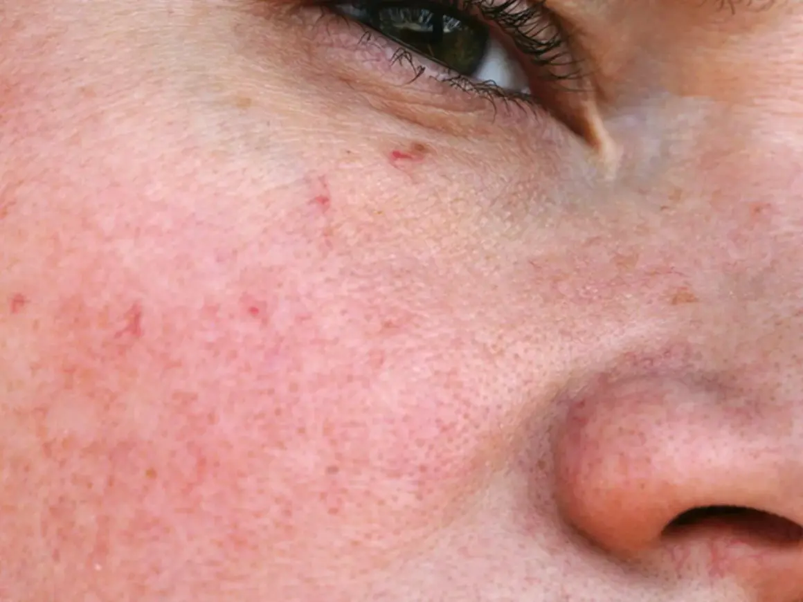 Nahaufnahme der Haut mit feinen roten Äderchen, die als besenreiser im Gesicht sichtbar sind.