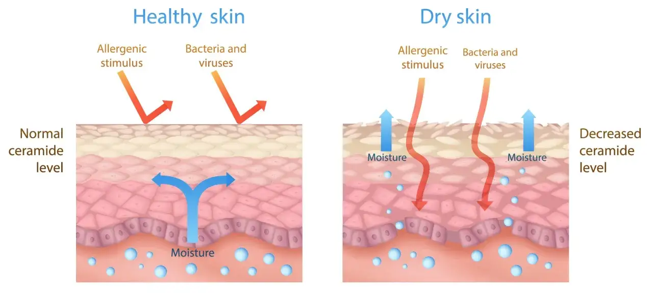 Gesunde Haut mit normalem Ceramid-Level schützt vor Allergenen. Trockene Haut mit weniger Ceramiden verliert Feuchtigkeit.
