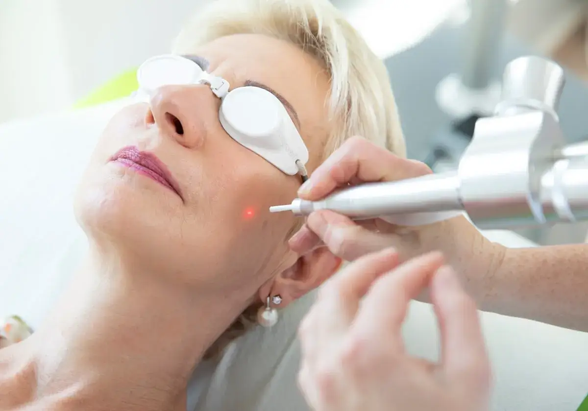 Frau mit Schutzbrille erh&auml;lt Laserbehandlung gegen besenreiser im gesicht. Ein roter Punkt zeigt die Behandlungsstelle.